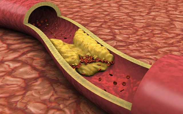 Invion ASX IVX life sciences capital raise next-gen photodynamic therapy treat infectious diseases atherosclerosis Photosoft