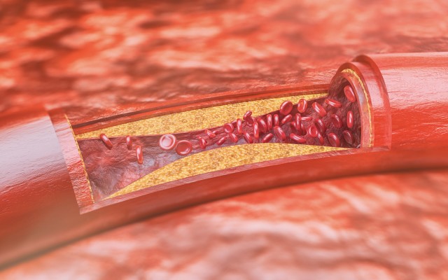 Invion Group ASX IVX Photosoft photodynamic therapy technology atherosclerosis infectious diseases cancer